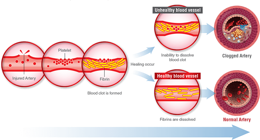 If Fibrinolytic Activity Is Decreased , Blood Clot - Nattokinase (848x456), Png Download