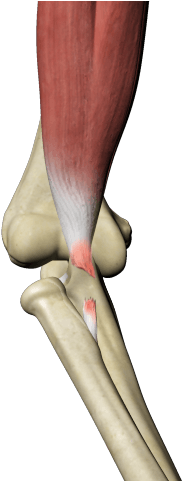Biceps Tendon Tear - Diatal Biceps Tendon Rupture (640x480), Png Download