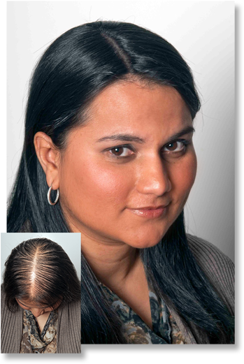 Thinning Hair - Does Thinning Hair Look Like Female (350x527), Png Download