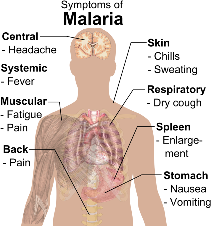 Symptoms Of Malaria (724x768), Png Download