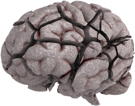 Choose A 'brain Break Or A Brain Brake' Making Choices - Bone Fracture (500x386), Png Download