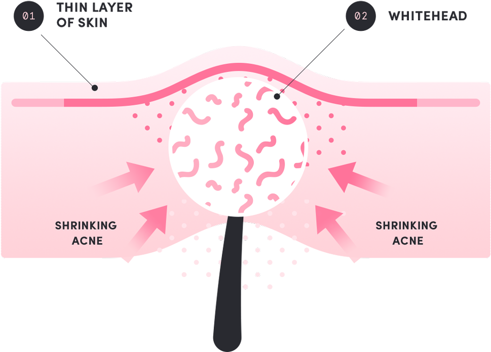 Death Of The Pimple - Acne (1000x715), Png Download