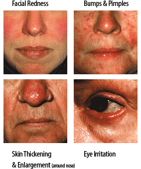 Many People Notice That Their Rosacea “flares” Or Symptoms - Red Face Stress (400x355), Png Download