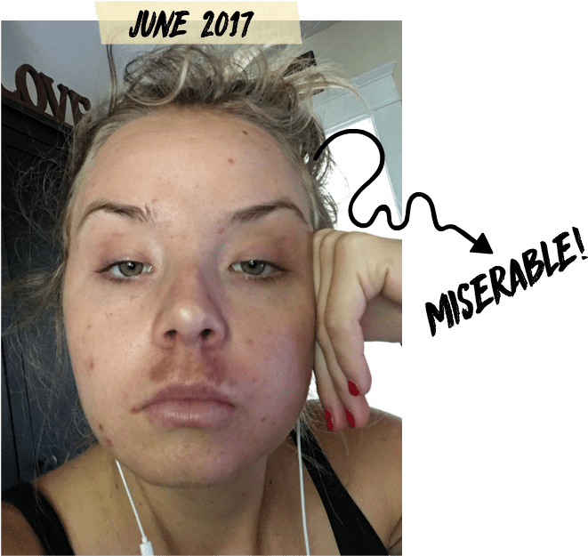 Those Little Popped Pimples You See Up There Turns - Melasma Mustache (722x669), Png Download
