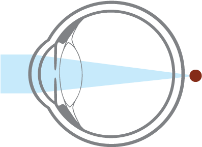 Hyperopia, Or Farsightedness, Occurs When An Eyeball - Circle (417x417), Png Download