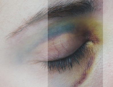 Helatomic-bruises - Cracked Spines (396x304), Png Download