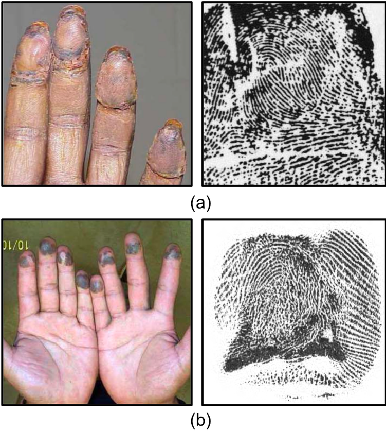 Example Images Of Altered Fingerprints - Fingerprint Alteration (750x852), Png Download