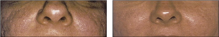 Acne Scar Treatment Results At Ablon Skin Institute - Ablon Skin Institute & Research Center (750x200), Png Download