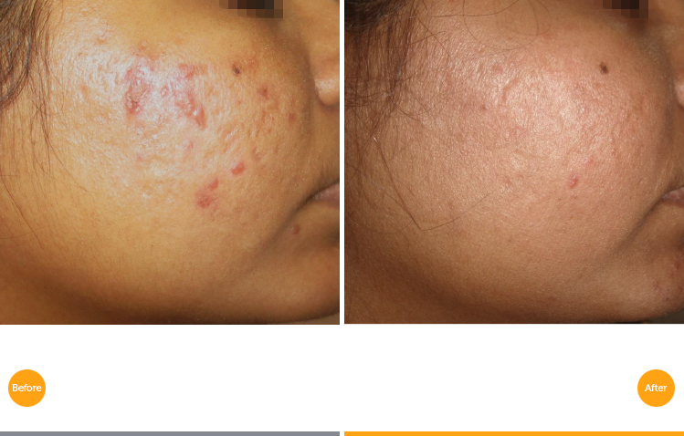 Acne Scar Revision After Tixel Treatment At Canary - Tixel For Acne Scars (749x478), Png Download