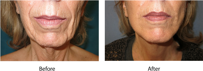 Click Here For Before And After Photos - Surfer Hair (677x245), Png Download