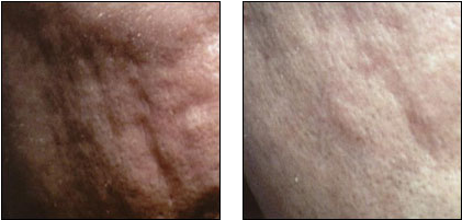 Acne Scar Treatment Results At Ablon Skin Institute - Scar (750x200), Png Download