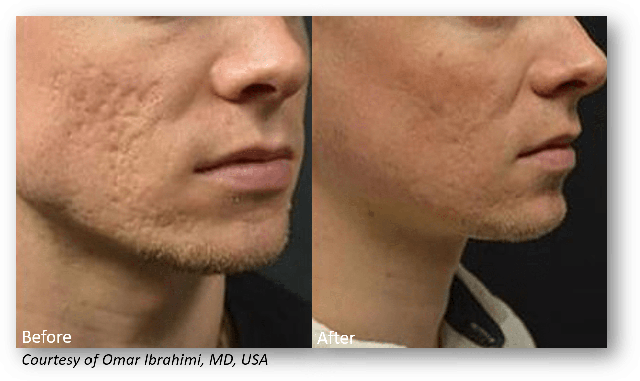 Benefits Of Infini Rf Microneedling - Results Of Rf Microneedling (1273x759), Png Download