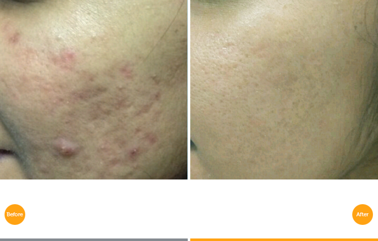 Acne Scars Treatment - Tixel Before And After Acne Scars (749x478), Png Download