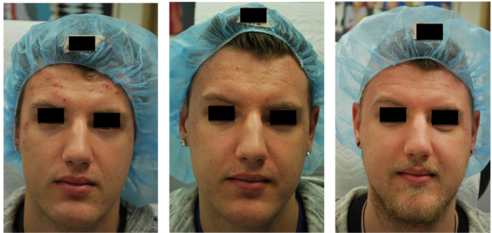 Acne And Acne Scarring And Pores Before , 2 Months - Acne (903x336), Png Download