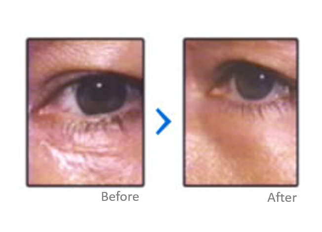 Scar Treatment Results - Contact Lens (740x540), Png Download
