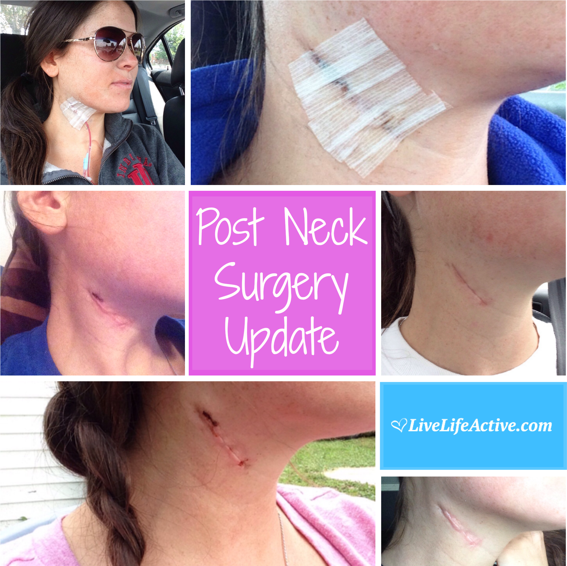 Branchial Cleft Cyst Removal Surgery Scar - Branchial Cyst Surgery Scar (2000x2000), Png Download