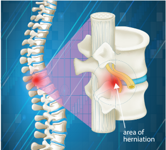 Our Chiropractors In Tucson Offer Treatment For Pinched - Area Spinal Column (450x300), Png Download