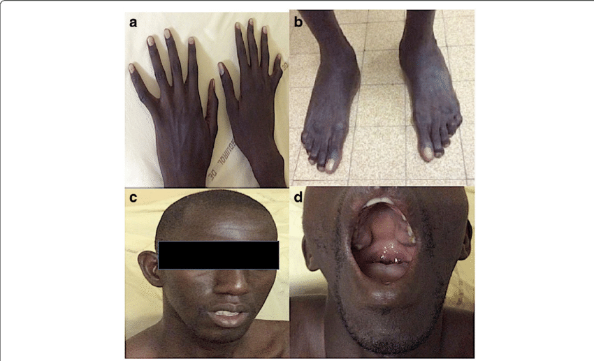Clinical Anomalies Of A Patient - High-arched Palate (850x517), Png Download
