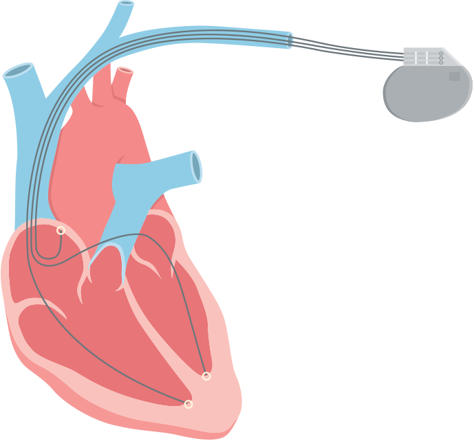 Systolic Heart Failure Also Called Systolic Left Ventricular - Labeled Diagram Of A Pacemaker (689x642), Png Download