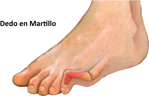 Causas - Hammer Toe (600x338), Png Download