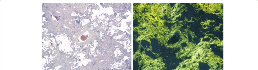 Ssc, Honeycomb-lung Characterized By Excessive Fibrous - Sea Lettuce (850x231), Png Download