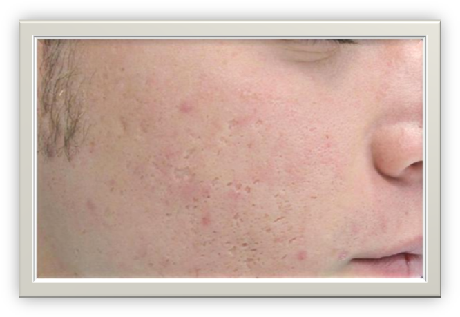 This Involves Using A Needle Or Cannula To Break The - Freckle (682x476), Png Download