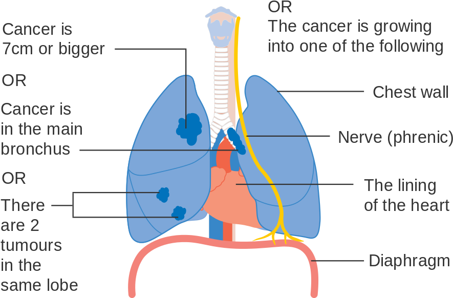 Lung Cancer Stages Pictures - Lung Cancer Staging (732x510), Png Download