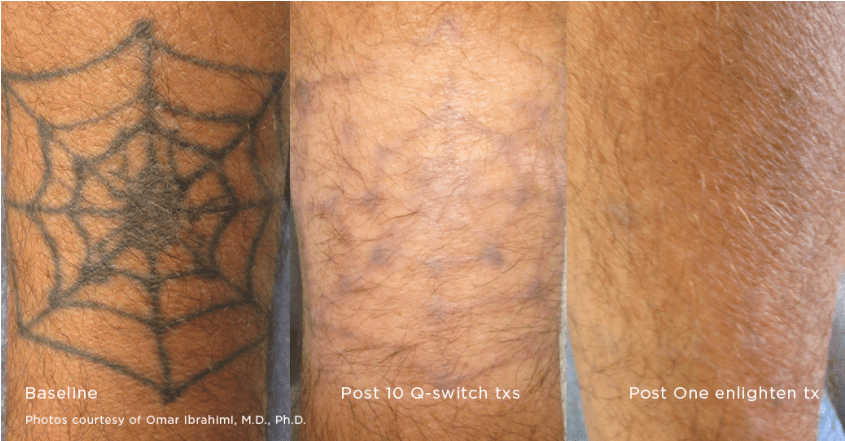 Tattoo Removal* - Tattoo (1060x440), Png Download