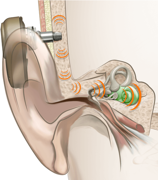 Bahs What Is Bone Conduction How It - Bone Conduction (960x600), Png Download