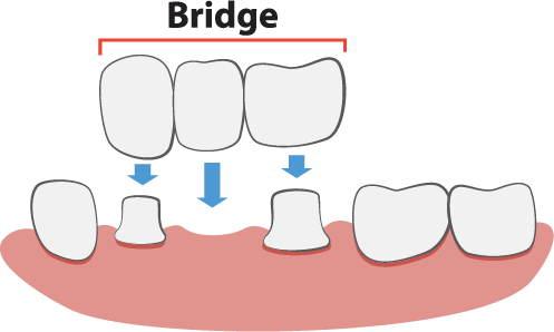 Dental Bridges Illustration - Dental Bridge Illustration (497x298), Png Download