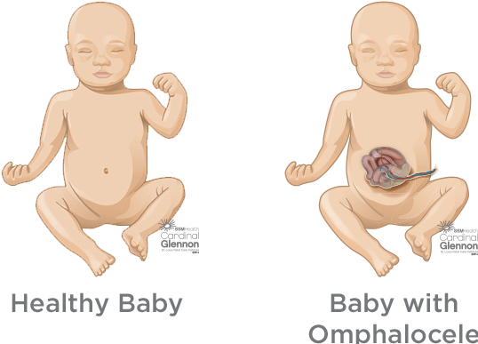 Typically, During Week 6 To 10 Of Pregnancy, A Baby's - Pulmonary Hypoplasia (618x516), Png Download