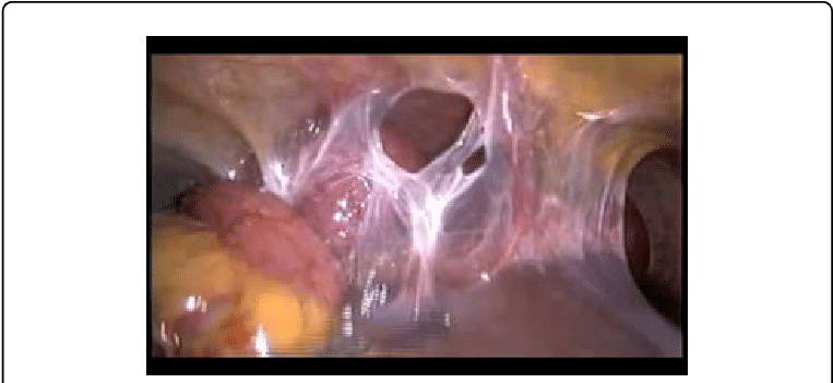 Photograph Showing The Dilated Small Intestines Trapped - Small Intestine (769x354), Png Download