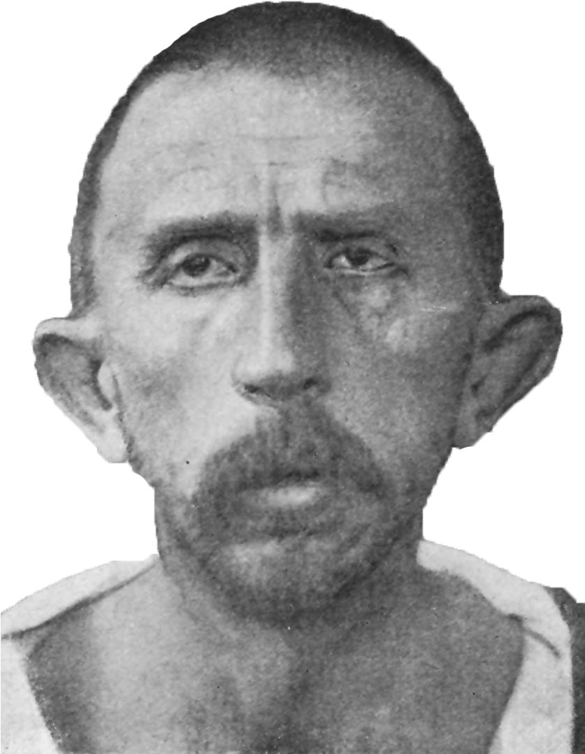 Schizophrenia Congenital Idiot, Age - Wikimedia Commons (836x1113), Png Download