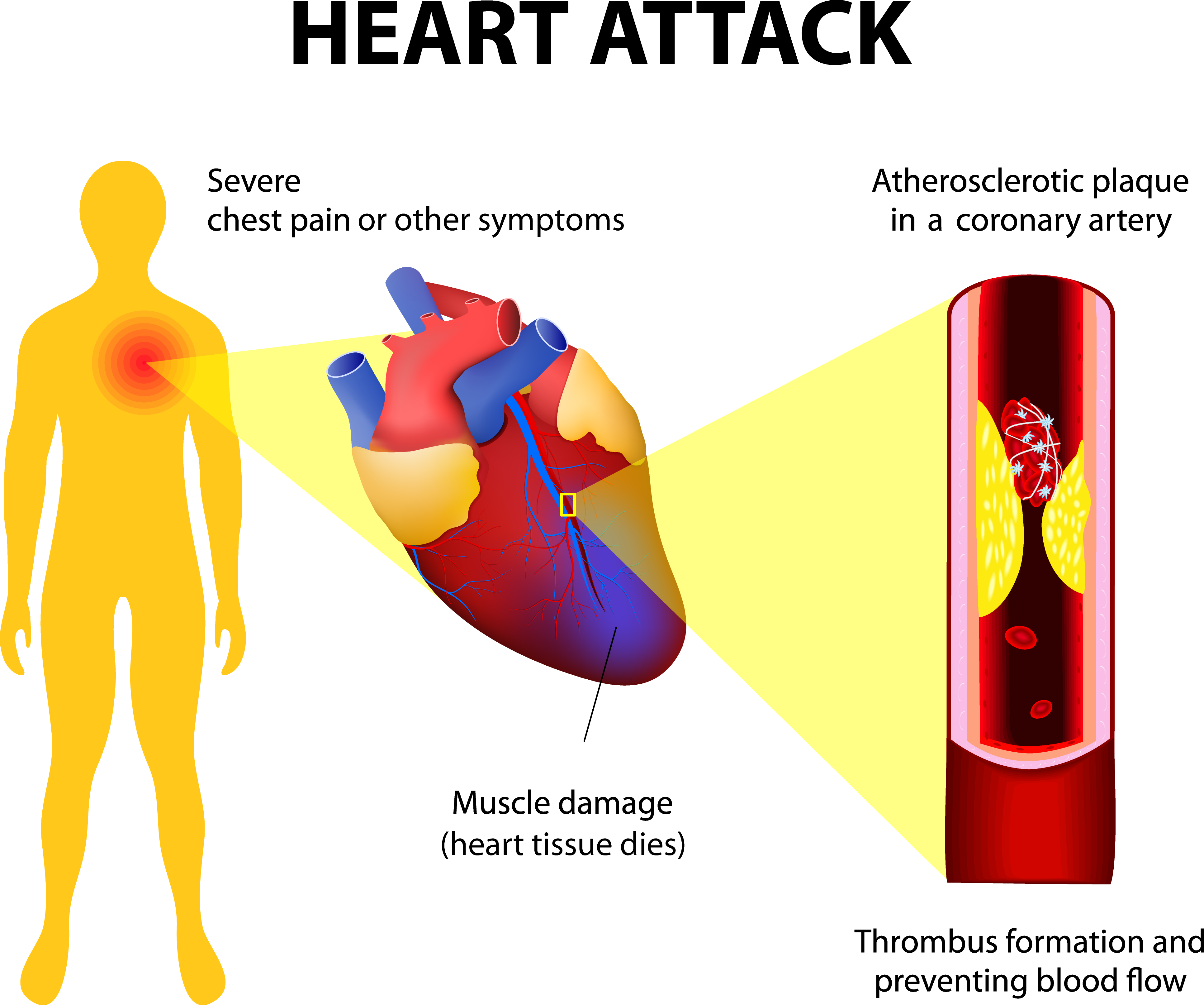 Heart-attack2 Adobestock - Myocardial Infarction Full Body (3866x3225), Png Download