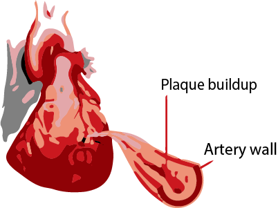 Myocardial Infarction (402x301), Png Download