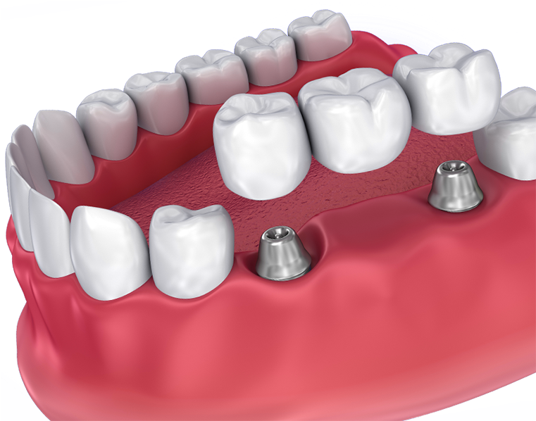 Dental Crowns (760x733), Png Download