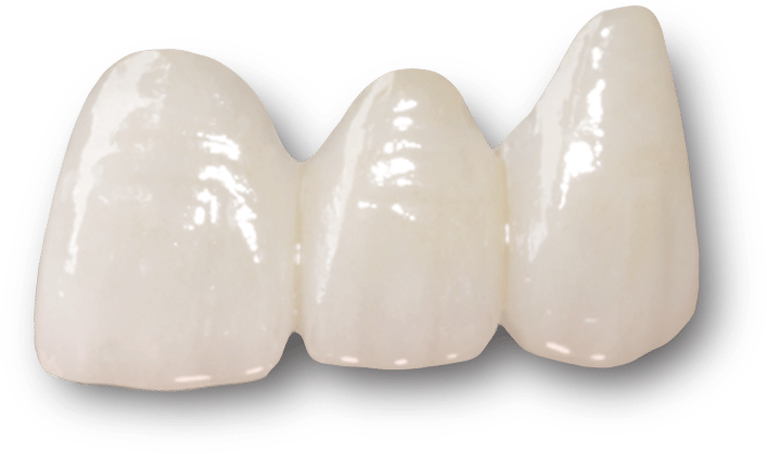 Ceramic Dental Bridges - Emax Crown (825x464), Png Download