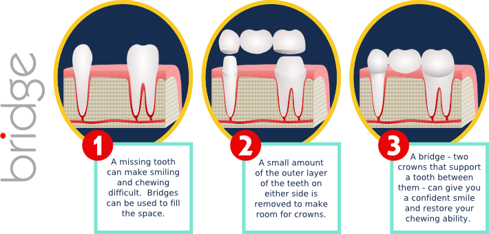 Fpd - Inlays And Onlays (710x340), Png Download