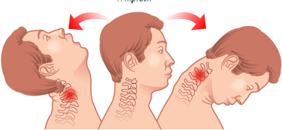 Whiplash Injuries Cause Pain - Whiplash Injury (604x270), Png Download