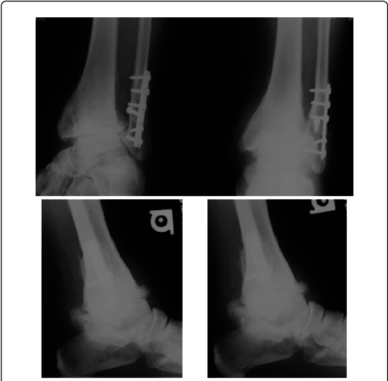 Ap, Mortise And Flexion Extension X Rays Of An Osteoarthritic - Radiography (769x751), Png Download