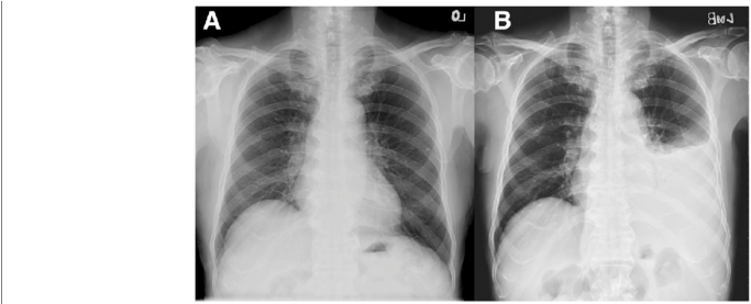 Chest X-rays Showed Normal Heart Size, Sharp Cardiopleural - Coronary Stent (850x276), Png Download