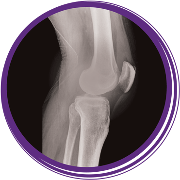 Photo Of An X-ray Of A Knee Joint - Rochelle Community Hospital (400x489), Png Download