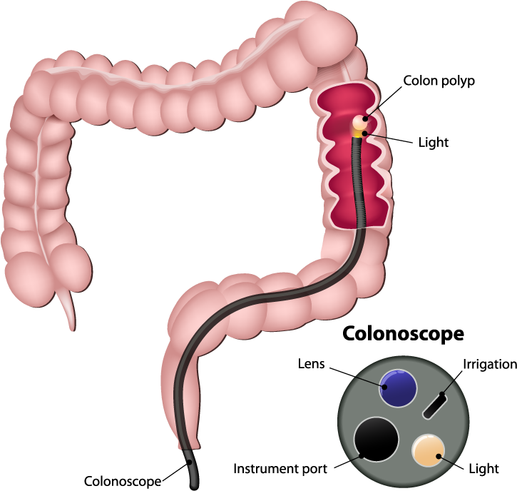 Colonoscopy - Colon Cancer (789x735), Png Download