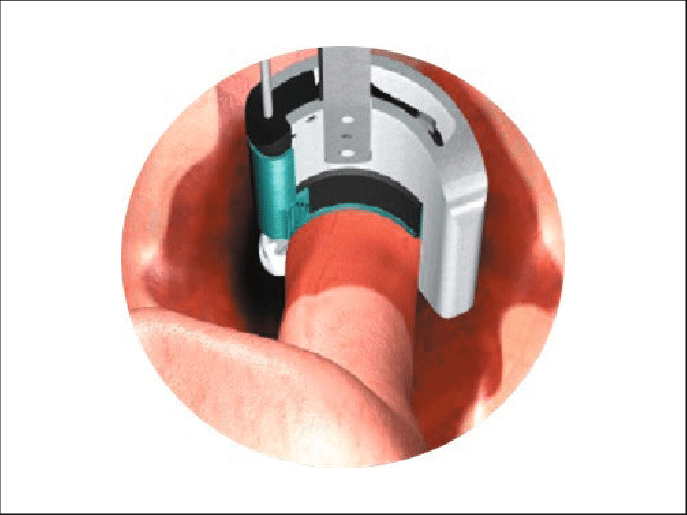 Schematic Show Of The Curvilinear Cut Of The Colon - Large Intestine (687x515), Png Download