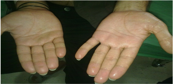 Difference Between Left Sympathectomised And Right - Ring (902x275), Png Download