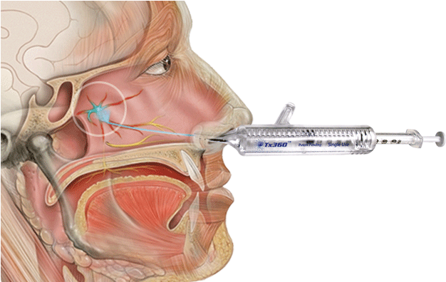 Headache/migraine Program - Mirx Protocol - Nasal Applicator (664x395), Png Download