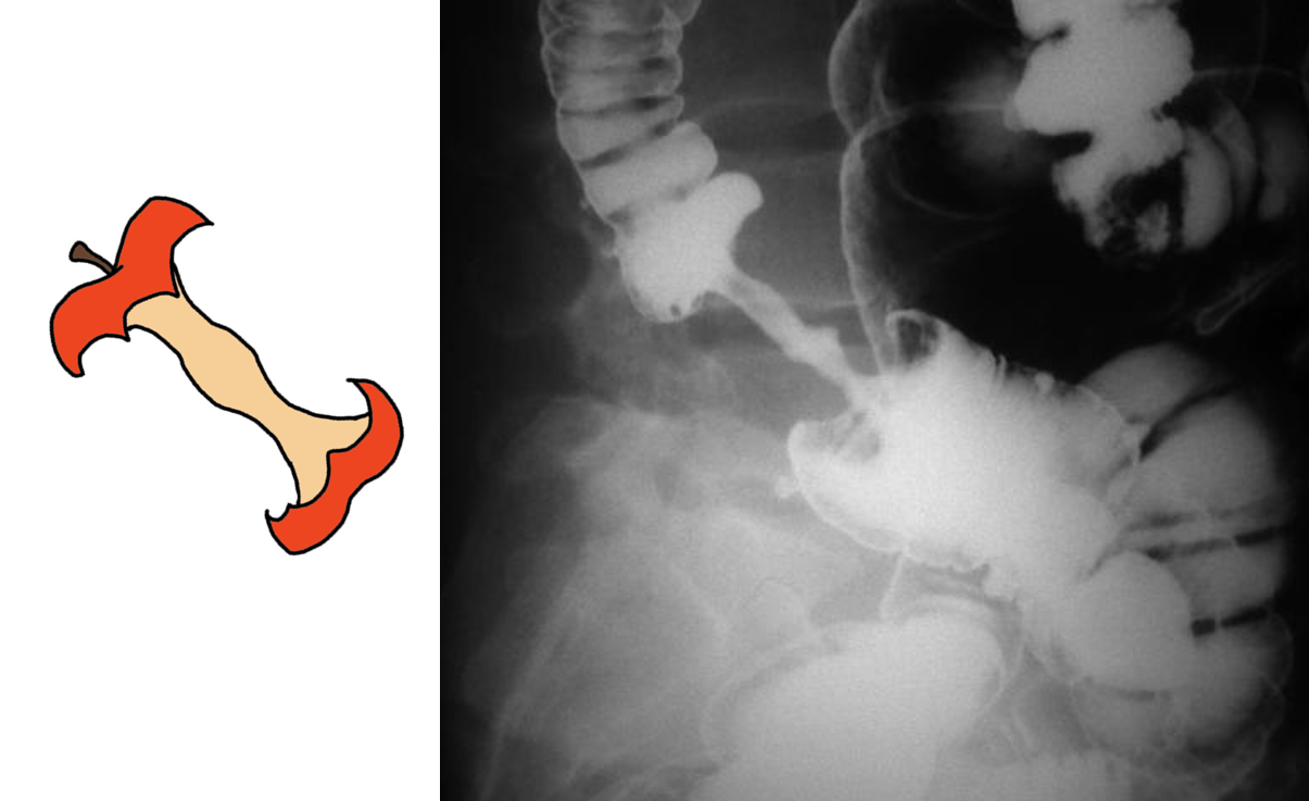 Colorectal Cancer Barium Enema (1205x737), Png Download