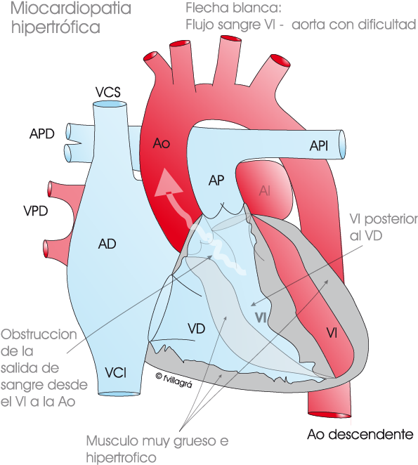 Miocardiopatía Hipertrófica - Mch Obstructiva (610x680), Png Download