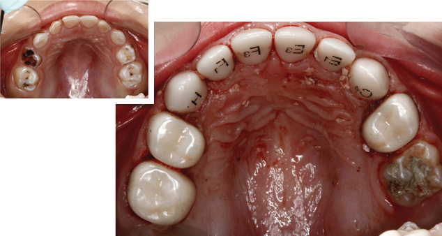 That Looks Natural, And Is Strong And Long Lasting - Ez Pedo Crown (634x338), Png Download