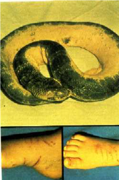 Photo Of Wounds Inflicted On The Victim And The Snake - Photograph (640x585), Png Download